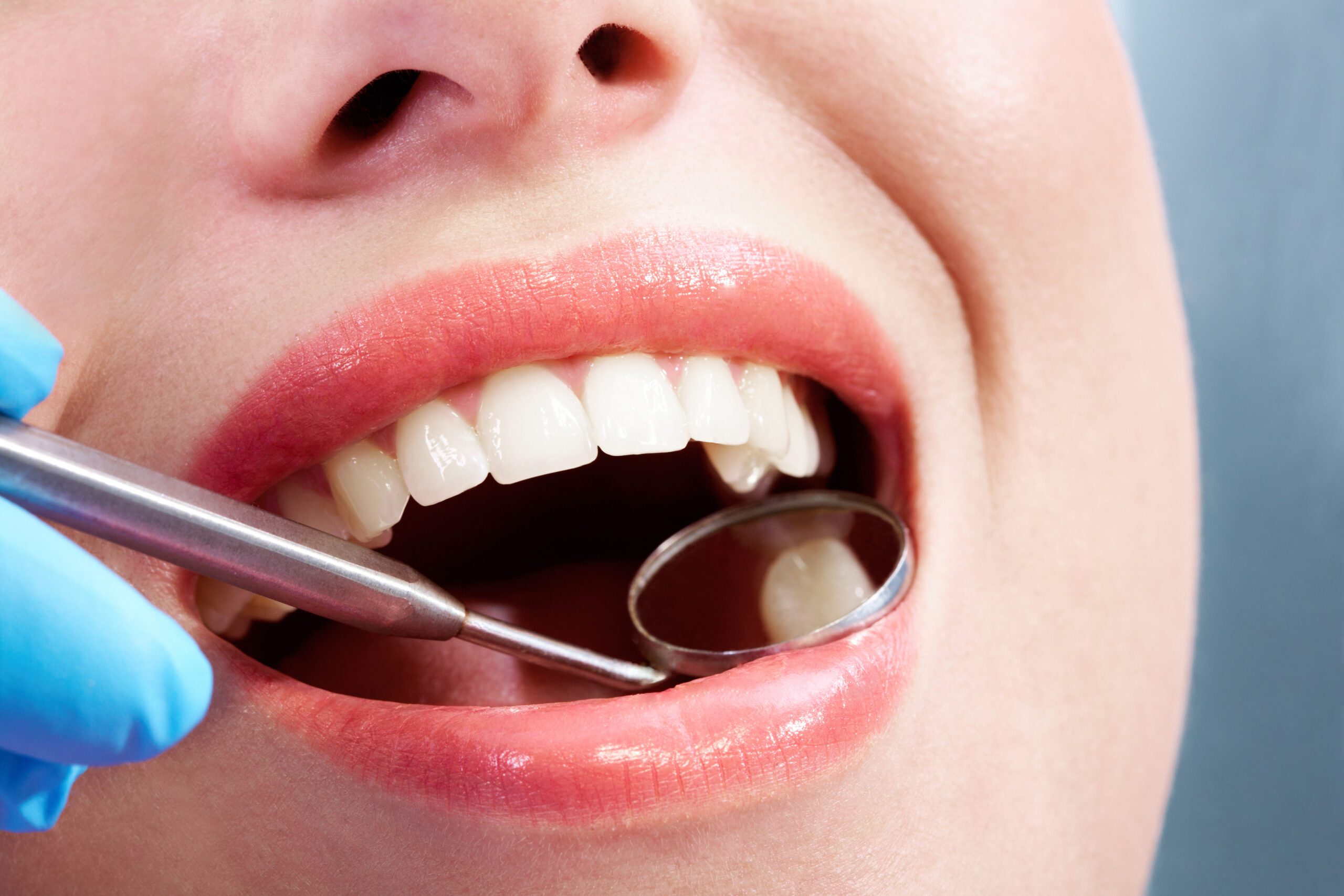 fillings katy dentist